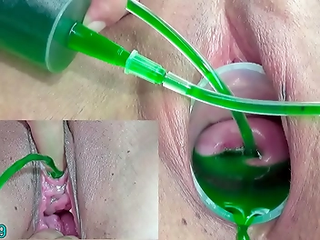 Japanese Lesbian Couple Experiencing Cervix And Pee Hole Inflation With Injections